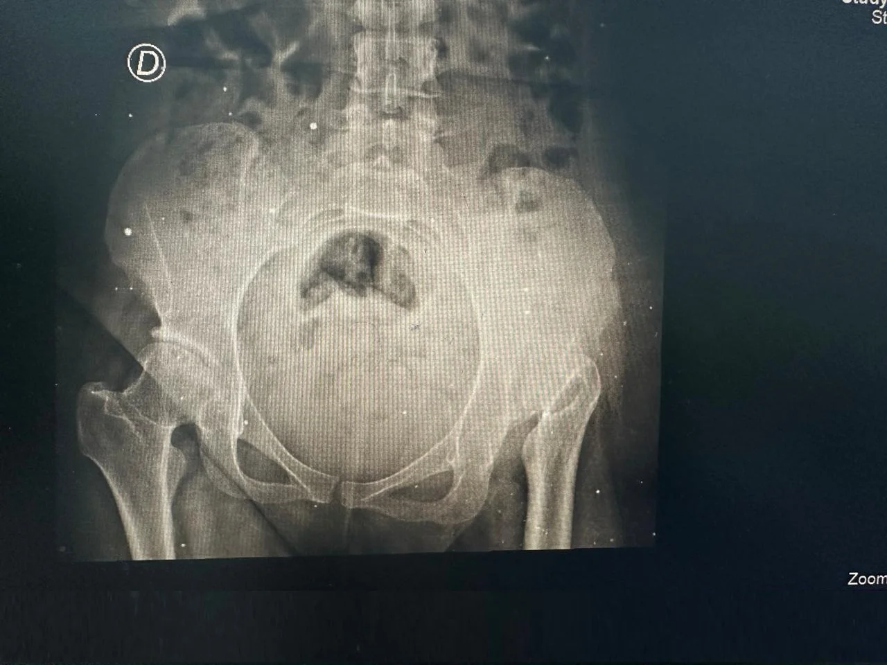 Radiografía preoperatoria mostrando desgaste articular severo en cadera derecha - Dra. Ana Luz Bernabe