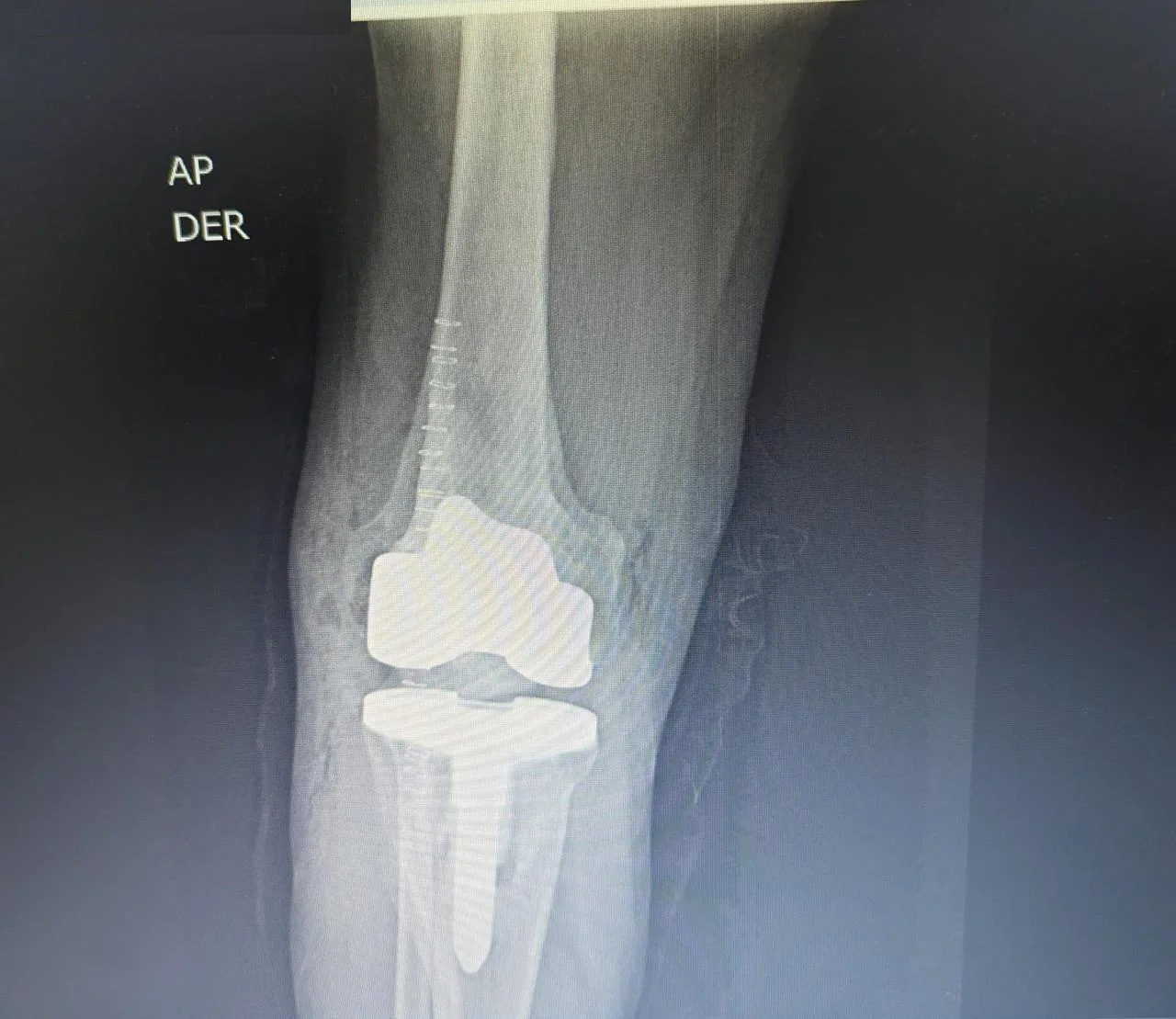 Radiografía postoperatoria de reemplazo articular de rodilla tras fractura de tibia