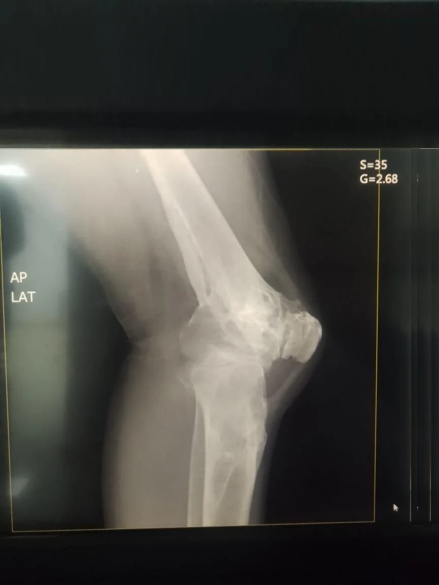 Radiografía preoperatoria de fractura de tibia y osteoartrosis de rodilla
