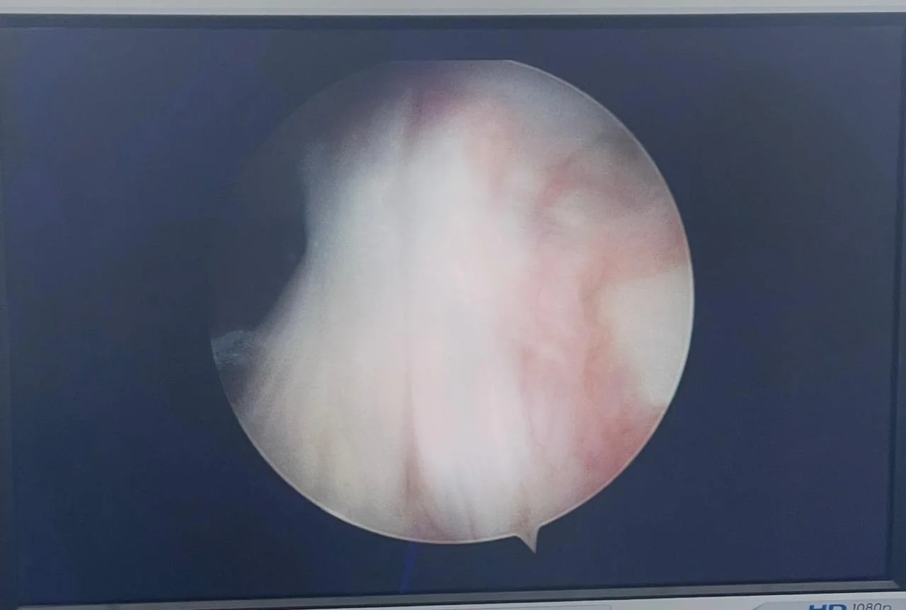 Recuperación tras cirugía artroscópica de reconstrucción de LCA y menisco - Medicina deportiva